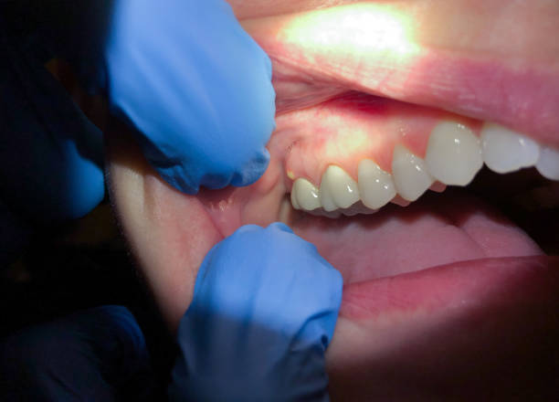 Best Emergency Tooth Extraction in Wilberforce, OH